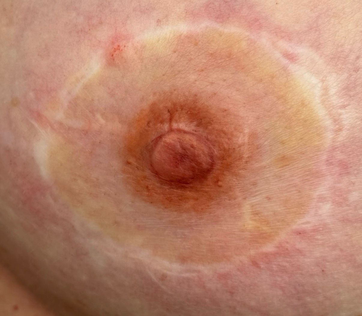 Areola Pigmentierung Frankfurt Nachher