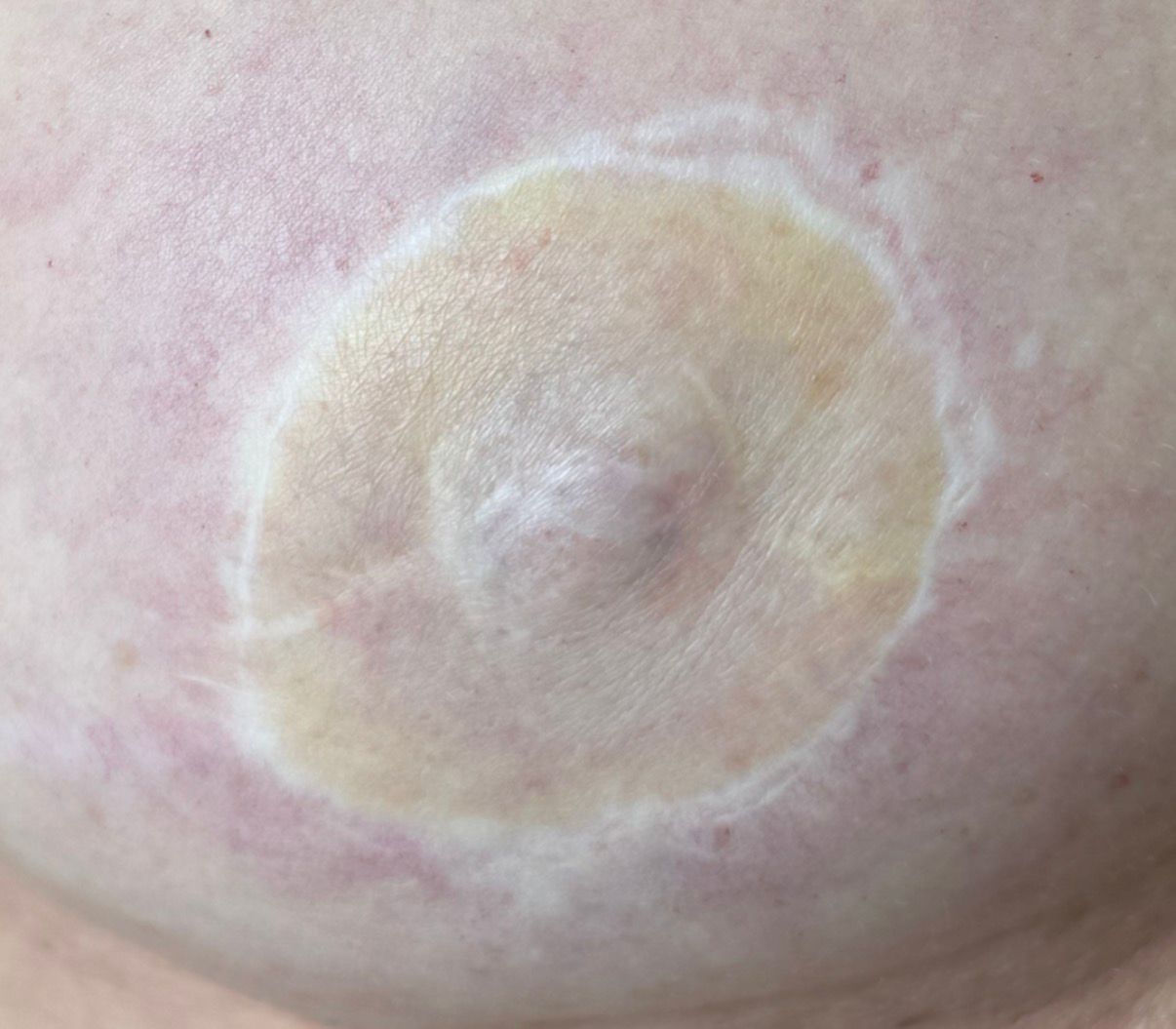 Areola Pigmentierung Frankfurt Vorher